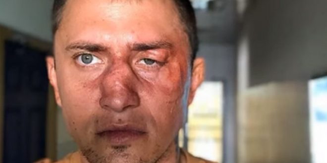 Секс-символ российского кино госпитализирован со страшными переломами лицевых костей: поскользнулся или сильно избили